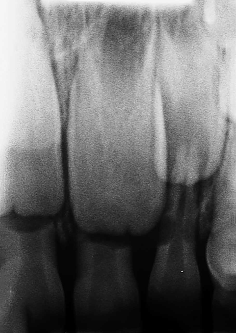 Abb. 11 Infektionsbedingte Wurzelresorption an Zahn 62.