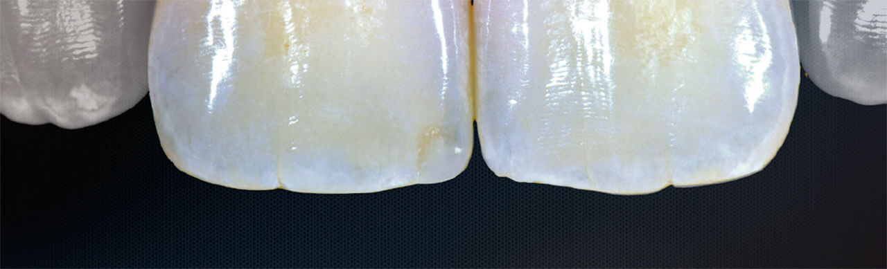 Klinisches Bild einer Oberkieferfront, Zahnkronen im Detail