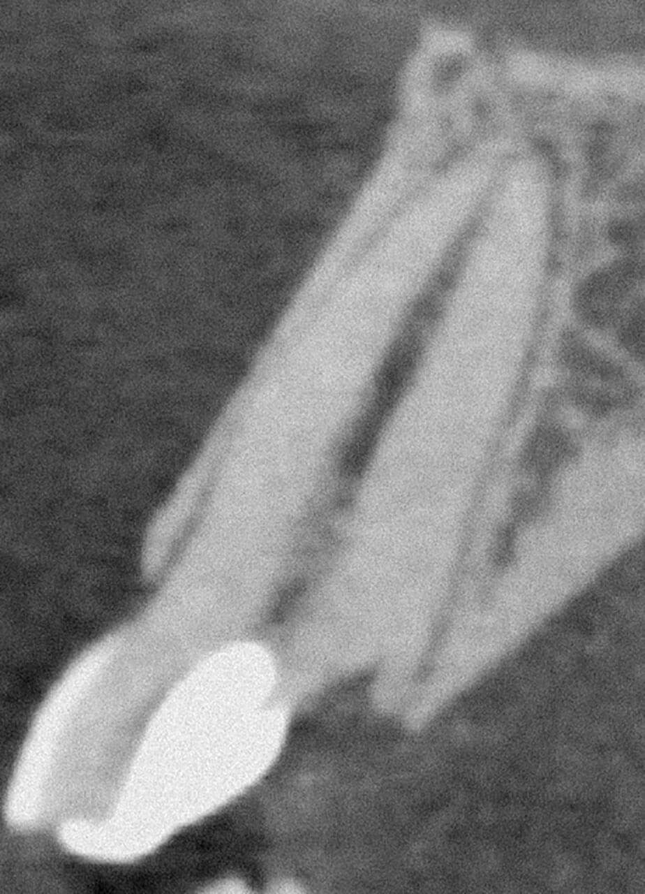 Digitals Volumentomographbild zeigt einen Oberkieferzahn von der Seite (Sagittalschnitt) mit palatinal krestaler „Zacke“ in der Zahnhartsubstanz.