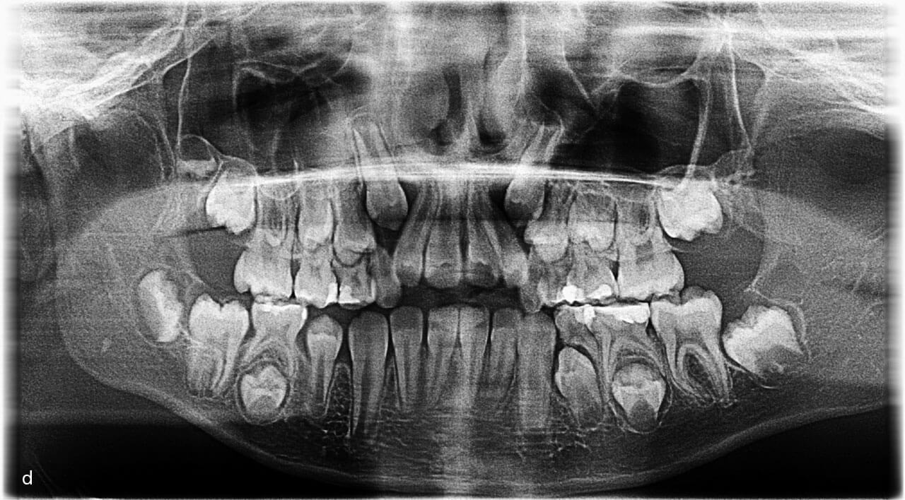 Abb. 1d Auf dem korrespondierenden Röntgenbild sieht es so aus, als hätte der Zahn 46 die knöcherne Bedeckung bereits weitgehend resorbiert. Anhand des Seitenvergleichs sowie der bereits fortgeschrittenen Ausbildung der Wurzel lässt sich jedoch erkennen, dass ein Durchbruchshindernis vorliegt.