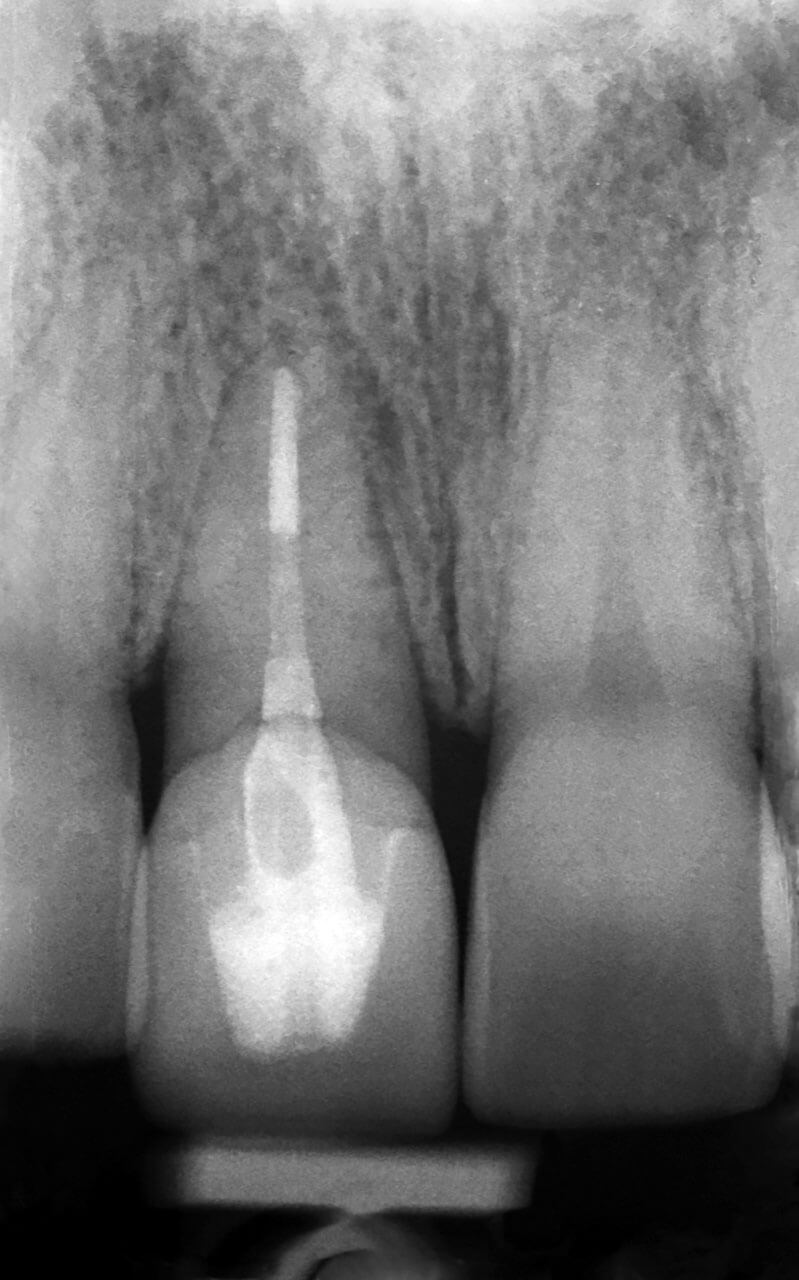 Abb. 17 Röntgenbild 1,5 Jahre nach intentioneller Replantation: apikal und periradikulär unauffällige knöcherne Verhältnisse. Der Parodontalspalt ist durchgängig verfolgbar.