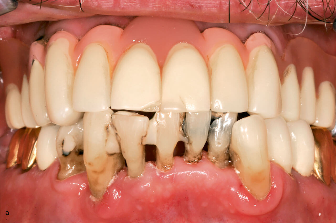 Abb. 3 a Klinische Ausgangssituation: Bestehende Doppelkronenversorgung im OK und im UK nicht erhaltbare Zähne.