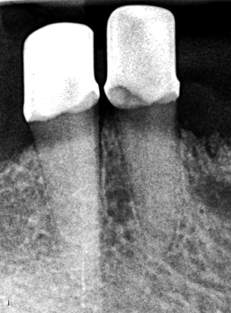  Abb. 3 i-k Zahnfilme 6 Jahre nach Doppelkronenversorgung der Zähne 47, 45, 44, 33, 34 und 35.