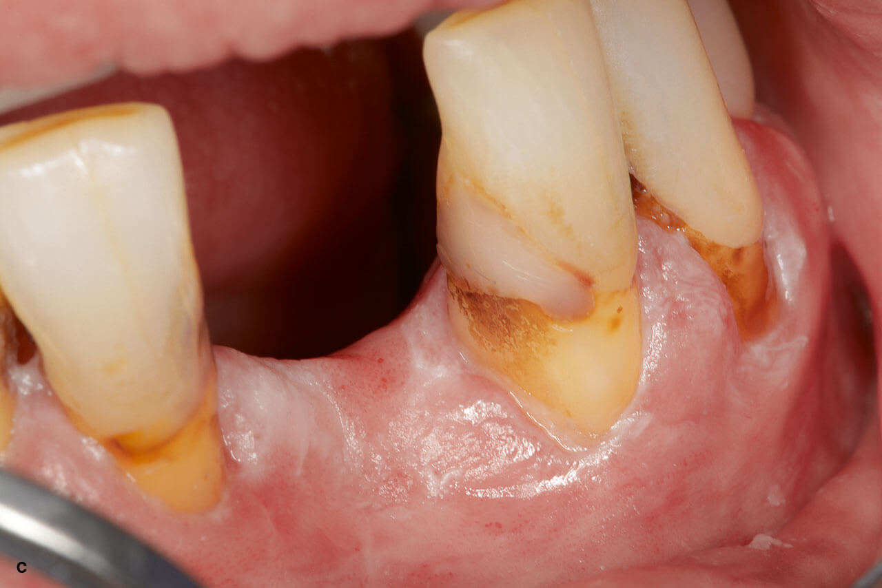 Abb. 5c Nach 6 Monaten wies der Randbereich der Restauration an Zahn 32 weiterhin eine intakte Oberfläche auf. Der in Abb. 5a erkennbare Nebenbefund einer weißlichen Mundschleimhautveränderung am Gingivarand wurde in der Zwischenzeit exzidiert und histopathologisch als nichtmaligne klassifiziert.