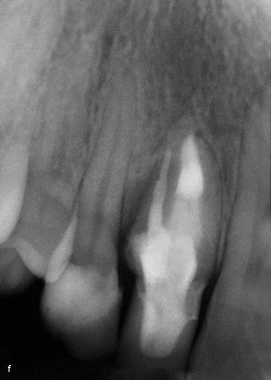 Abb. 5f Röntgenkontrolle sechs Monate nach definitiver Versorgung (e), Vollkeramikkrone zementiert.