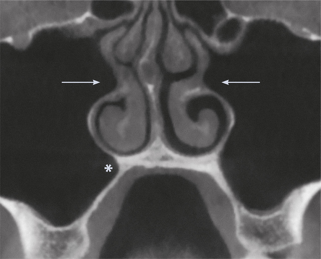 Abb. 2b DVT – koronale Ansicht. Beachte die mediale Ausdehnung der rechten Kieferhöhle (Pfeile) und die Ausprägung eines Recessus palatinus (*).