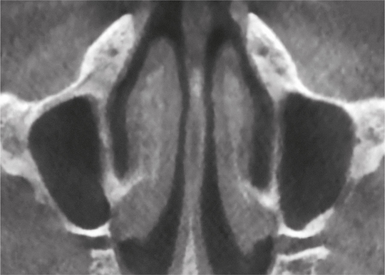 Abb. 3a DVT – axiale Ansicht. Hypoplasie beider Kieferhöhlen.