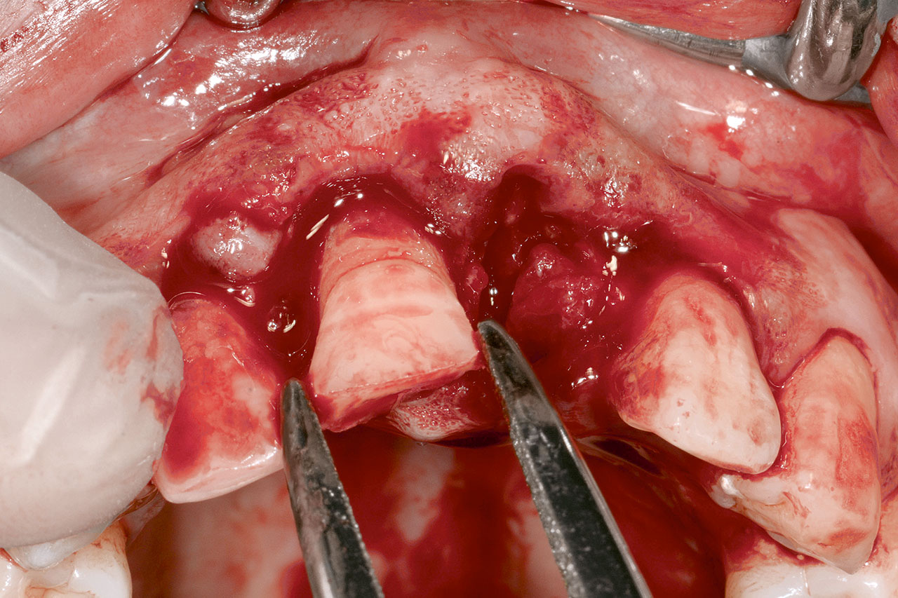 Abb. 3 Vorsichtige Entfernung des Zahnes 11 mittels Wurzelrestzange, danach Zwischenlagerung im Medium der Zahnrettungsbox mit NoResorb.