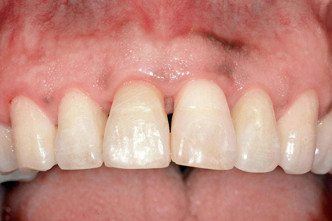 Abb. 13 Klinische Situation 3 Monate nach dem Unfall: Der Zahn 12 reagierte nicht auf den CO2-Test und war perkussionsempfindlich.