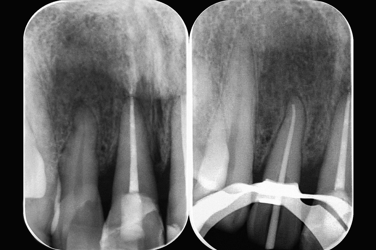 Abb. 14 Radiologische Kontrolle 3 Monate nach dem Unfall: apikale Parodontitis Zahn 12, was eine Wurzelkanalbehandlung zur Folge hatte.