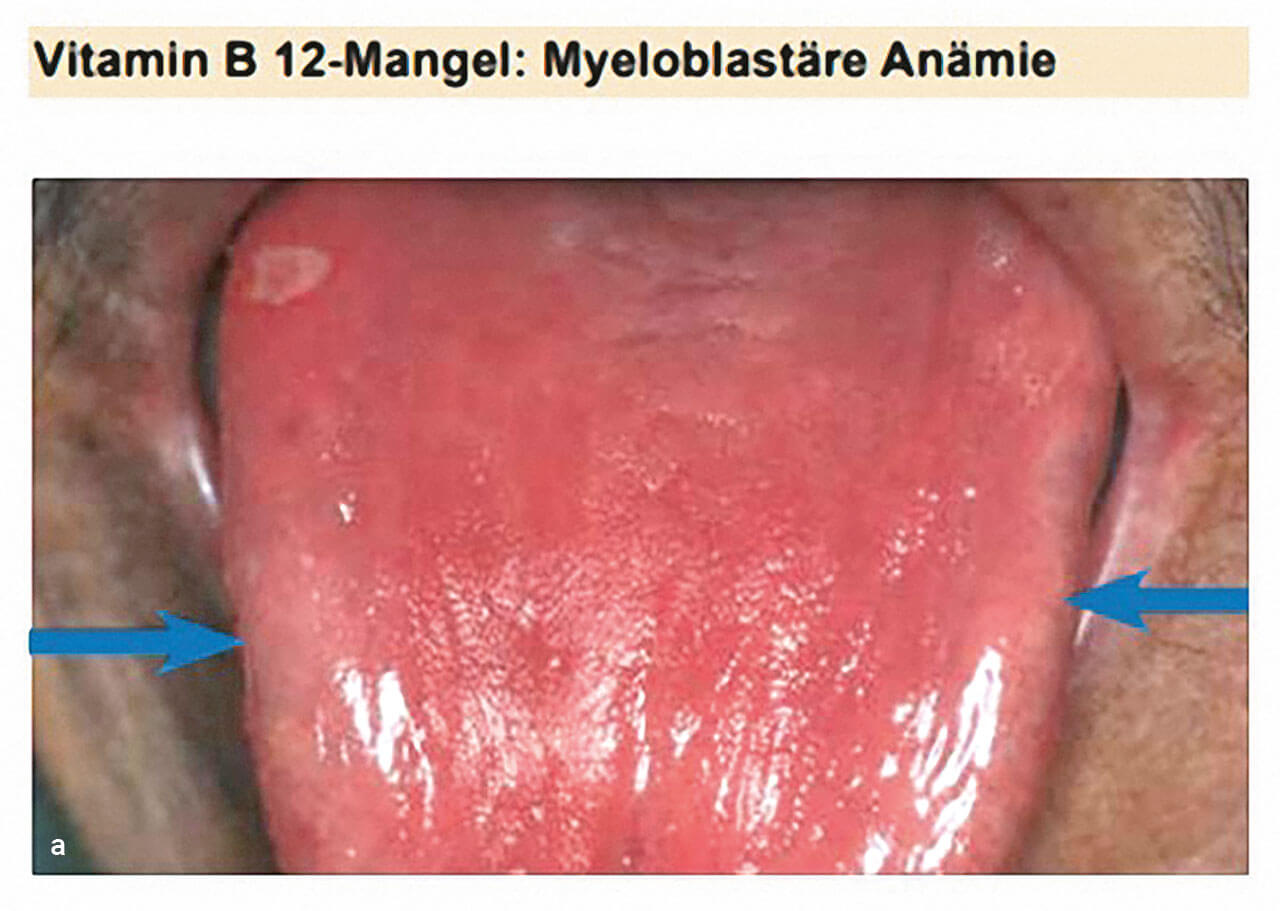 Abb. 3a und b Systematische klinische Einordnung am Beispiel der myeloblas­tären Anämie (oben) und der myeloischen Leukämie (unten).
