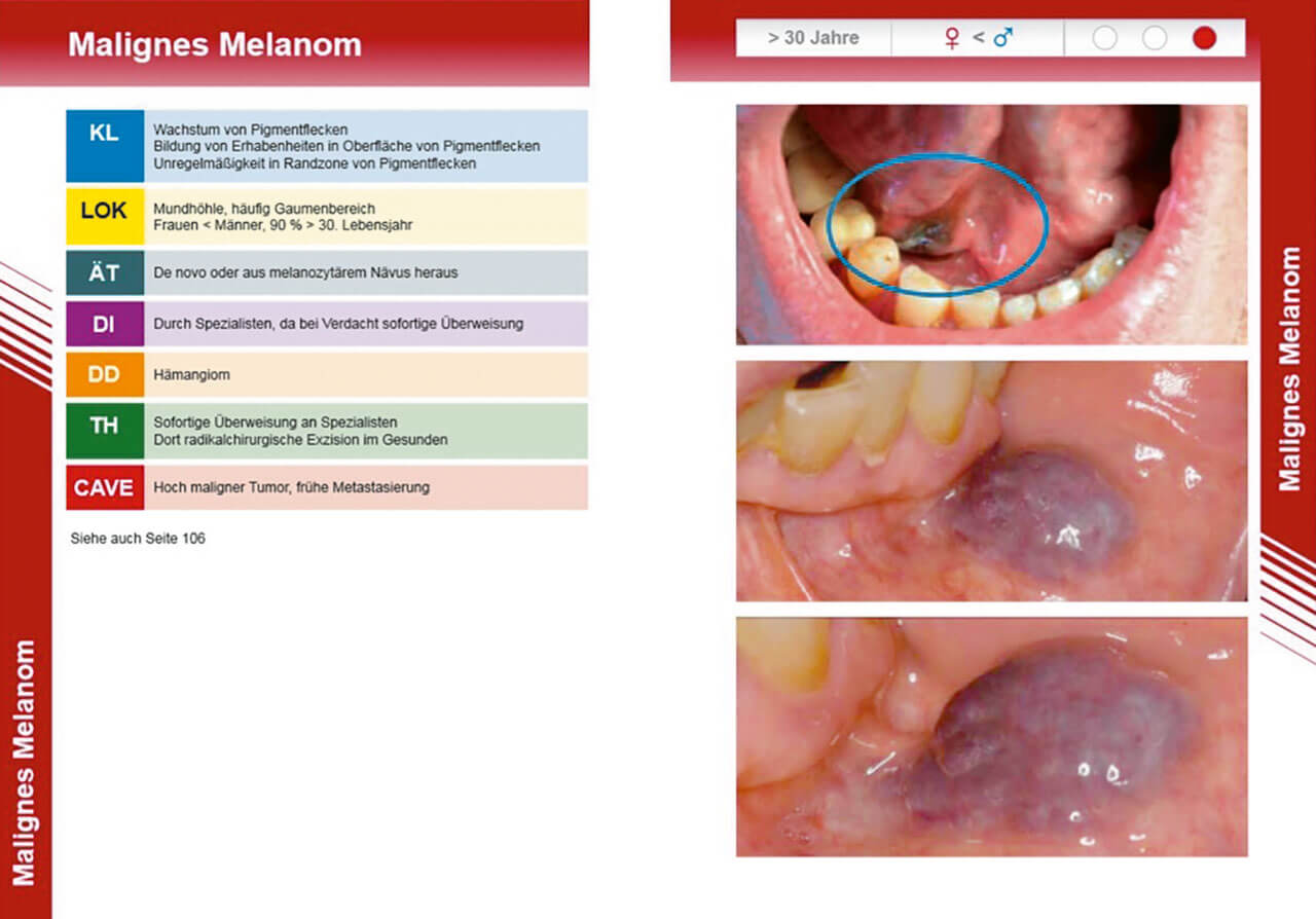 Abb. 6 Systematische klinische Einordnung am Beispiel des malignen Melanoms.
