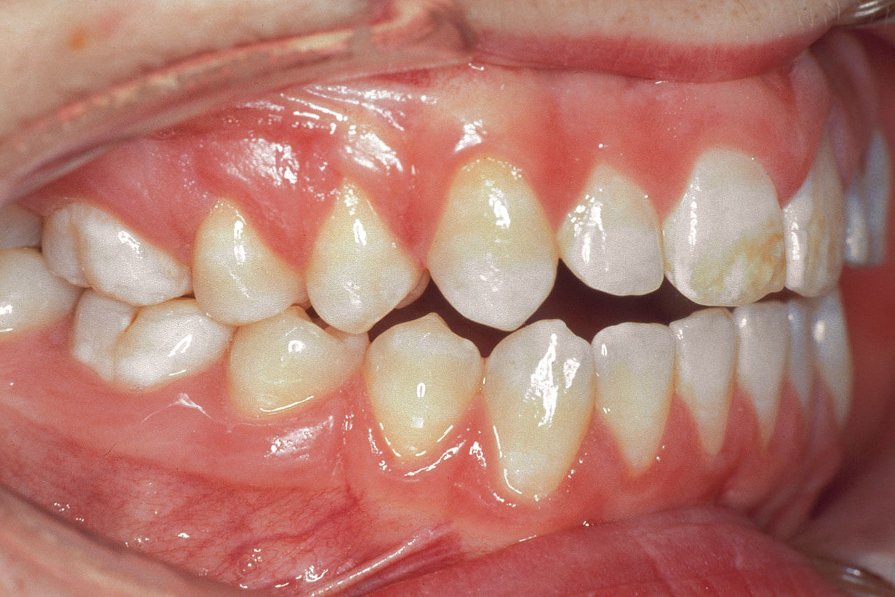 Abb. 5 Dentalfluorose im bleibenden Gebiss eines 15-jährigen Patienten.
