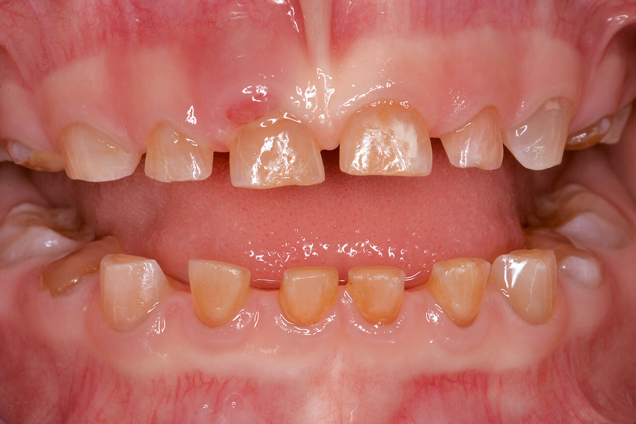 Abb. 6 Dentinogenesis imperfecta im Milchgebiss einer 4-jährigen Patientin.