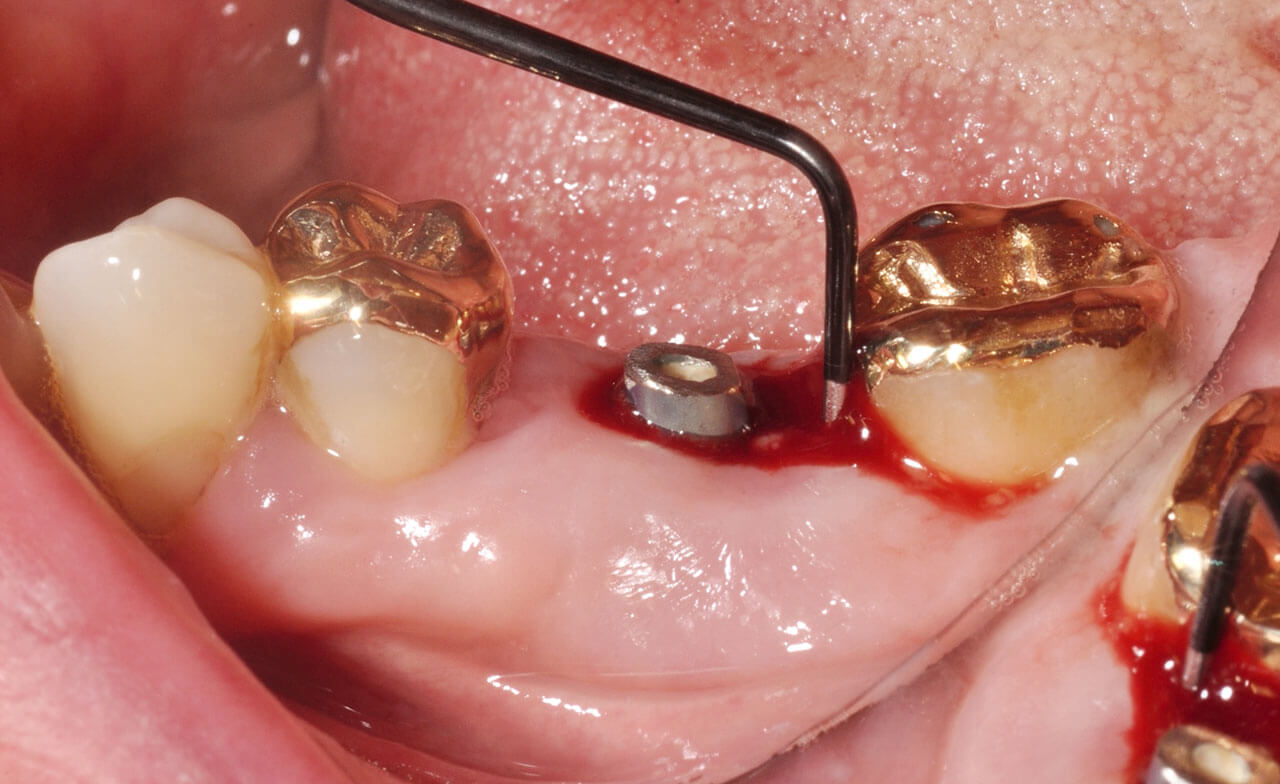 Abb. 2 Klinisches Bild einer Periimplantitis.