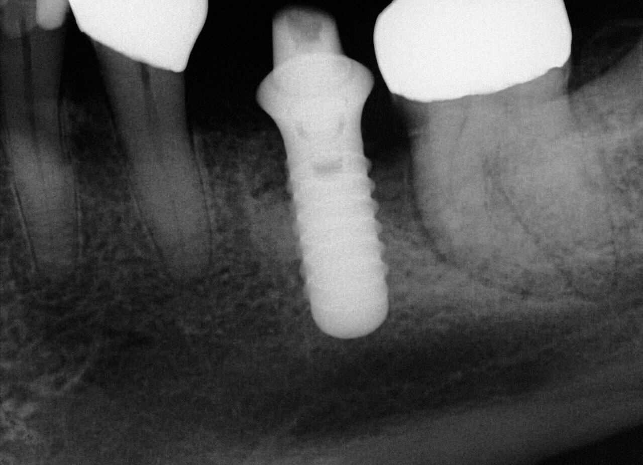 Abb. 3 Röntgenologisches Korrelat zu dem in Abbildung 2 gezeigten Implantat.