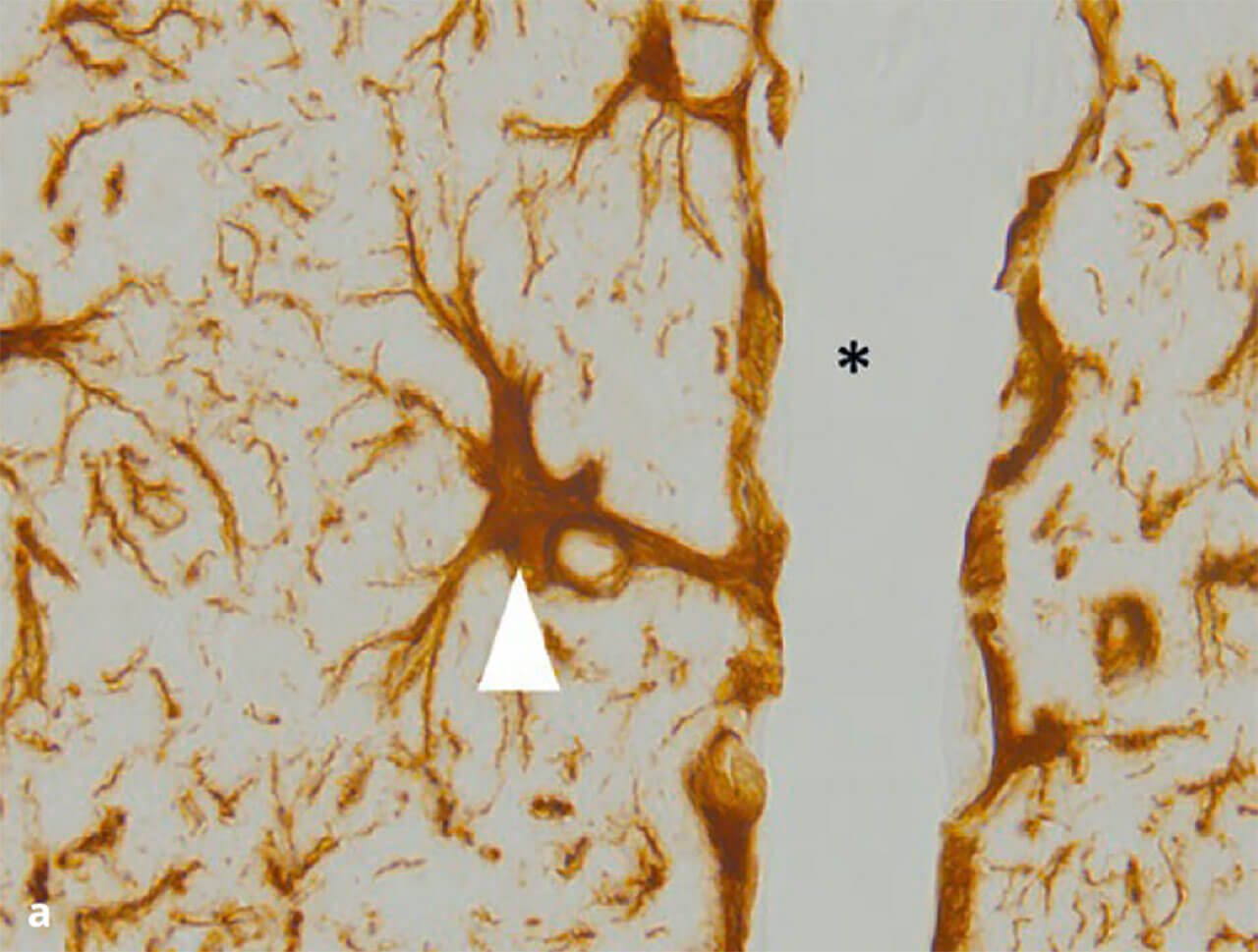 Abb. 8a und b Astrozyten übernehmen viele Aufgaben im Gehirn. Man unterscheidet die der weißen (fibrillären) und der grauen (protoplasmatischen) Substanz. Unter anderem bilden sie isolierende Barrieren nach außen hin, entweder in Richtung Hirnoberfläche  (a: Glia limitans superficialis) oder um Gefäße herum (b: Glia limitans perivascularis). Färbung gegen „Glial fibrillary acidic protein“ (GFAP). Pfeil in (a) = Zellkörper eines Astrozyten mit Ausbildung einer Glia limitans perivascularis. Stern in (a) = Lumen eines Gefäßes. Pfeil in (b)  Glia limitans superficialis. Stern in (b) Oberfläche des Gehirns.