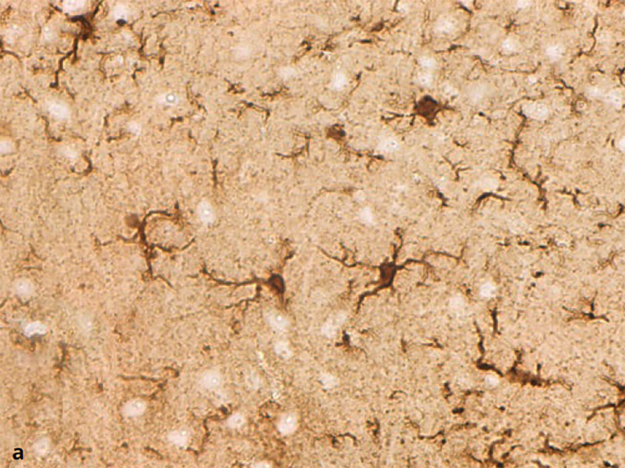 Abb. 11a und b Ruhende (a) und aktivierte (b) Mikroglia. Mikrogliazellen sind die Fresszellen des Zentralnervensystems. Ruhend haben sie einen kleinen Zellkörper und schlanke, verzweigte Fortsätze. Im aktivierten Zustand schwellen sie an und ziehen ihre Fortsätze ein (Färbung gegen das Protein IBA-1).
