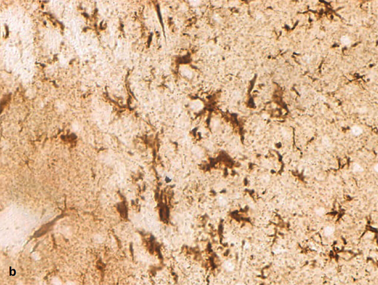 Abb. 11a und b Ruhende (a) und aktivierte (b) Mikroglia. Mikrogliazellen sind die Fresszellen des Zentralnervensystems. Ruhend haben sie einen kleinen Zellkörper und schlanke, verzweigte Fortsätze. Im aktivierten Zustand schwellen sie an und ziehen ihre Fortsätze ein (Färbung gegen das Protein IBA-1).