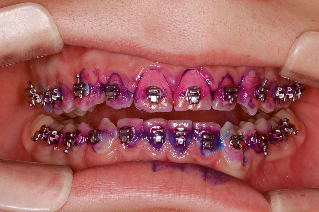 Abb. 8: Zustand nach Anfärben der Zähne eines 14-jährigen Patienten zum Aufzeigen der Schwachstellen der täglichen Mundhygiene