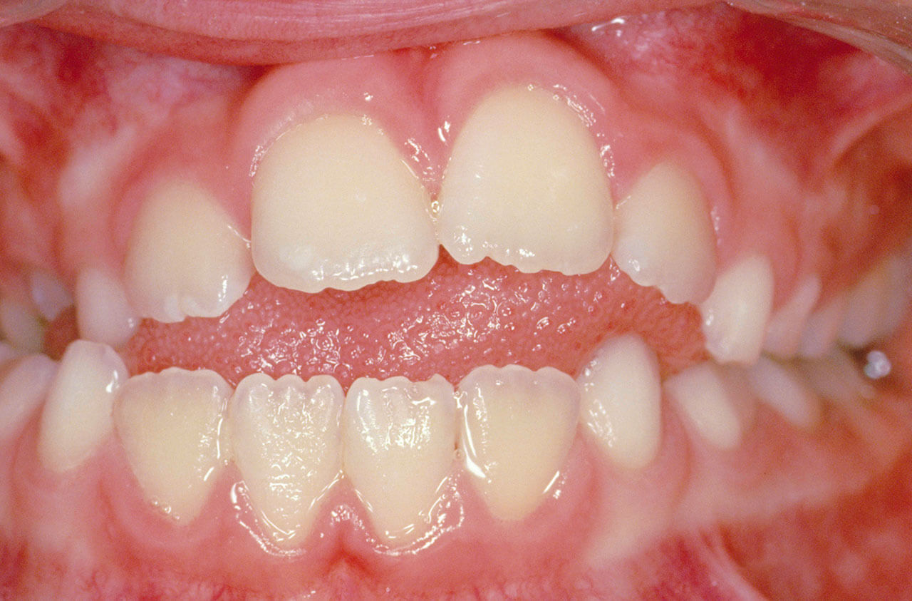 Abb. 5 Bei diesem zungenoffenen Biss drückt der Zungenmuskel gegen die Frontzähne und verhindert den korrekten Zahndurchbruch bis zur Okklusionsebene. Zusätzlich kommt es zu Protrusion der Schneidezähne.
