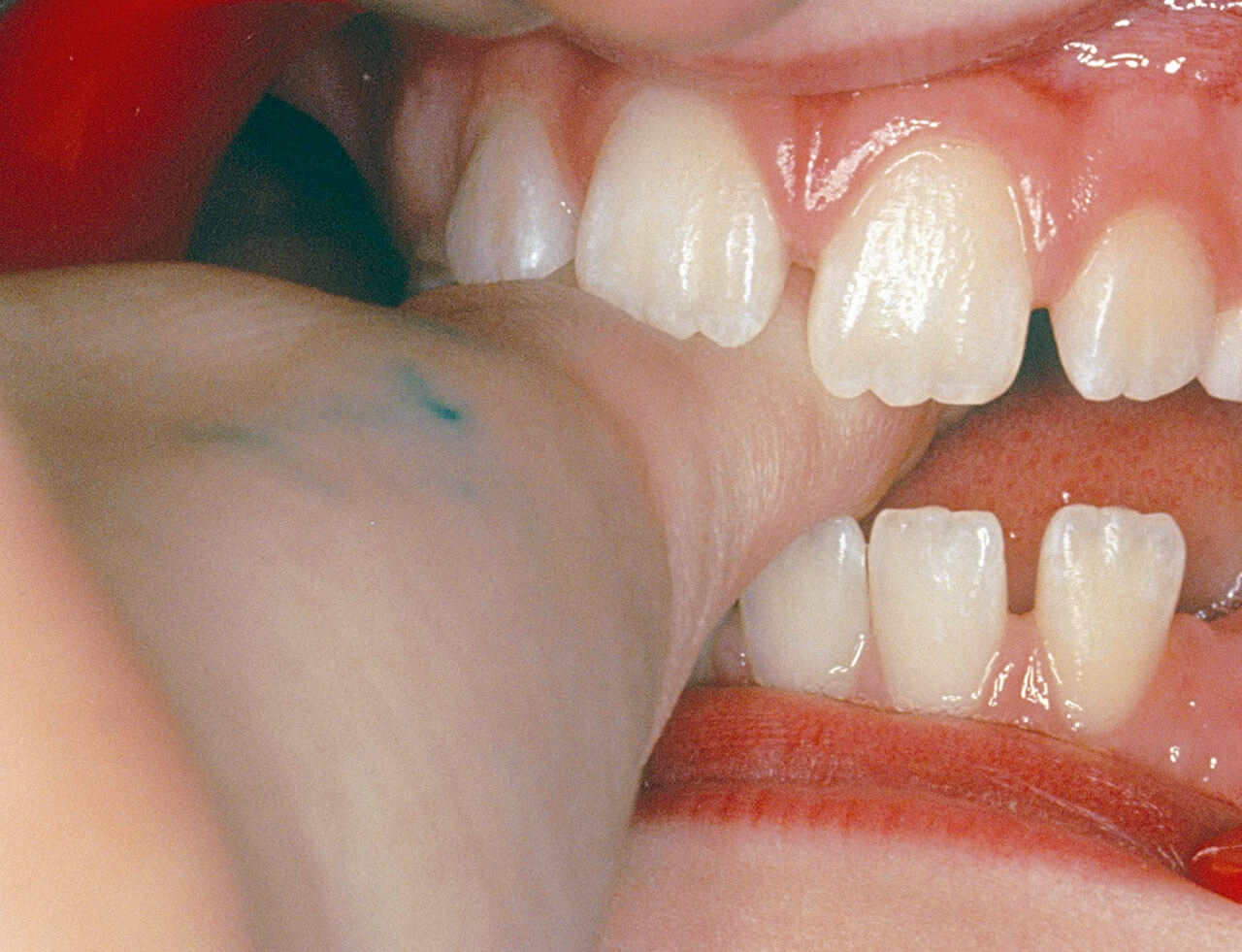Abb. 6 Bei diesem frontal offenen Biss sorgt der Druck des Lutschdaumens dafür, dass die Zähne nicht komplett bis zur Okklusionsebene durchbrechen können.
