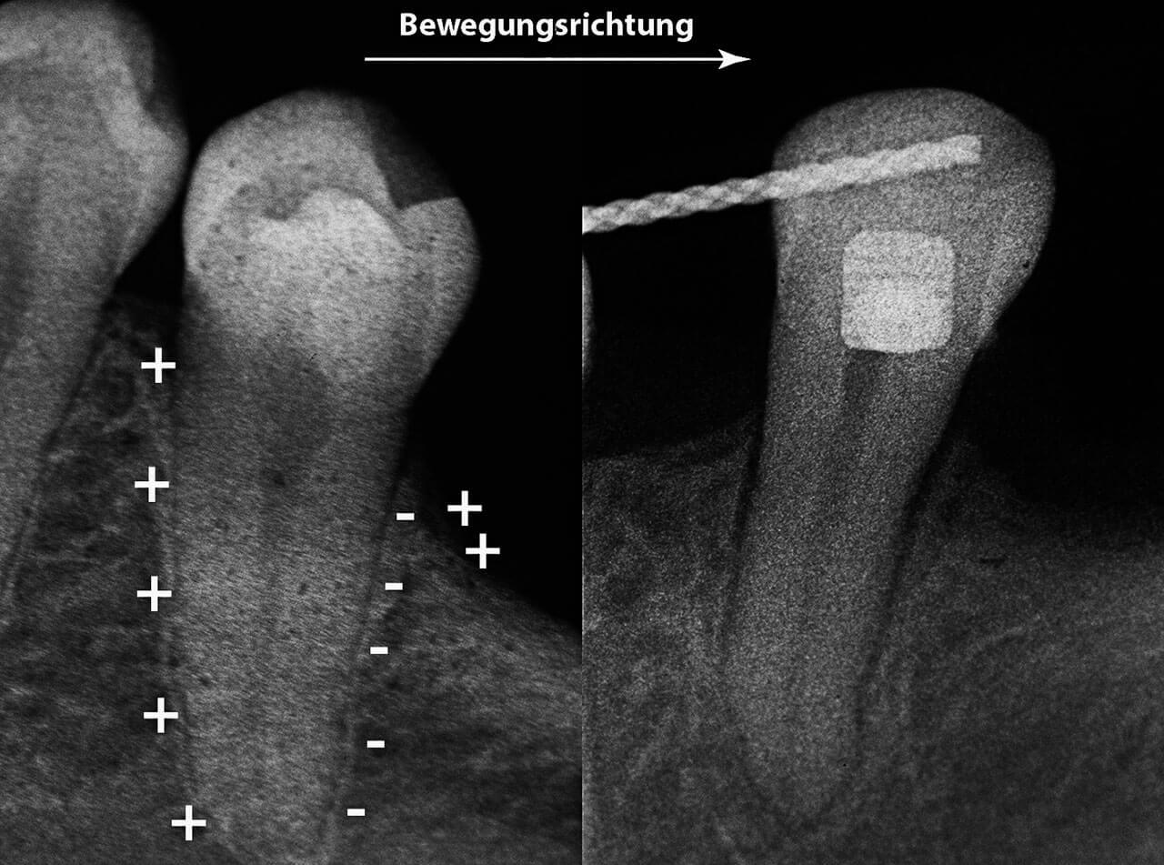 Abb. 10 Die Wanderung eines zweiten Prämolaren in den zahnlosen Bereich (nach rechts) fördert das Knochenwachstum in die Richtung, in die sich der Zahn bewegen wird. Der Zahn nimmt seinen Knochen mit und es entsteht eine zeltförmige Knochen-Zahn-Formation (rechter Bildteil).