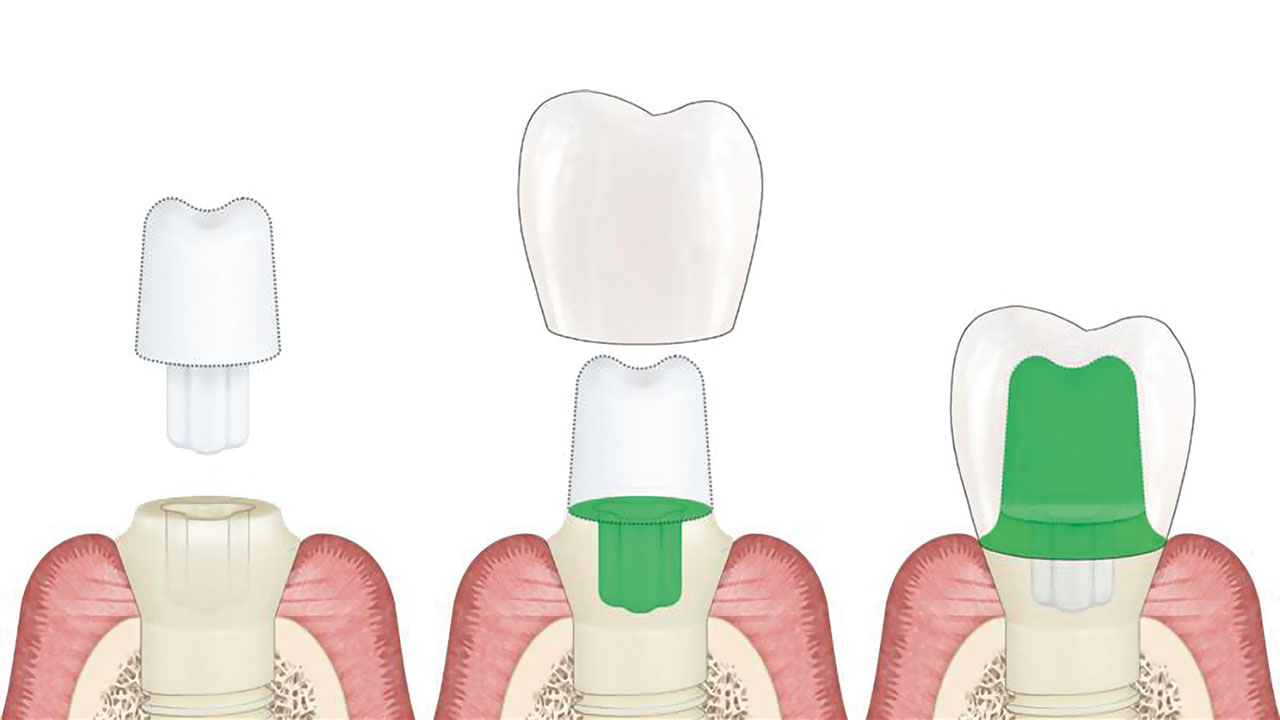 Abb. 3  Veranschaulichung der Verbindungsstellen: Implantatkörper-Abutment (mittlere Abbildung) und Abutment-Suprakonstruktion (rechte Abbildung).