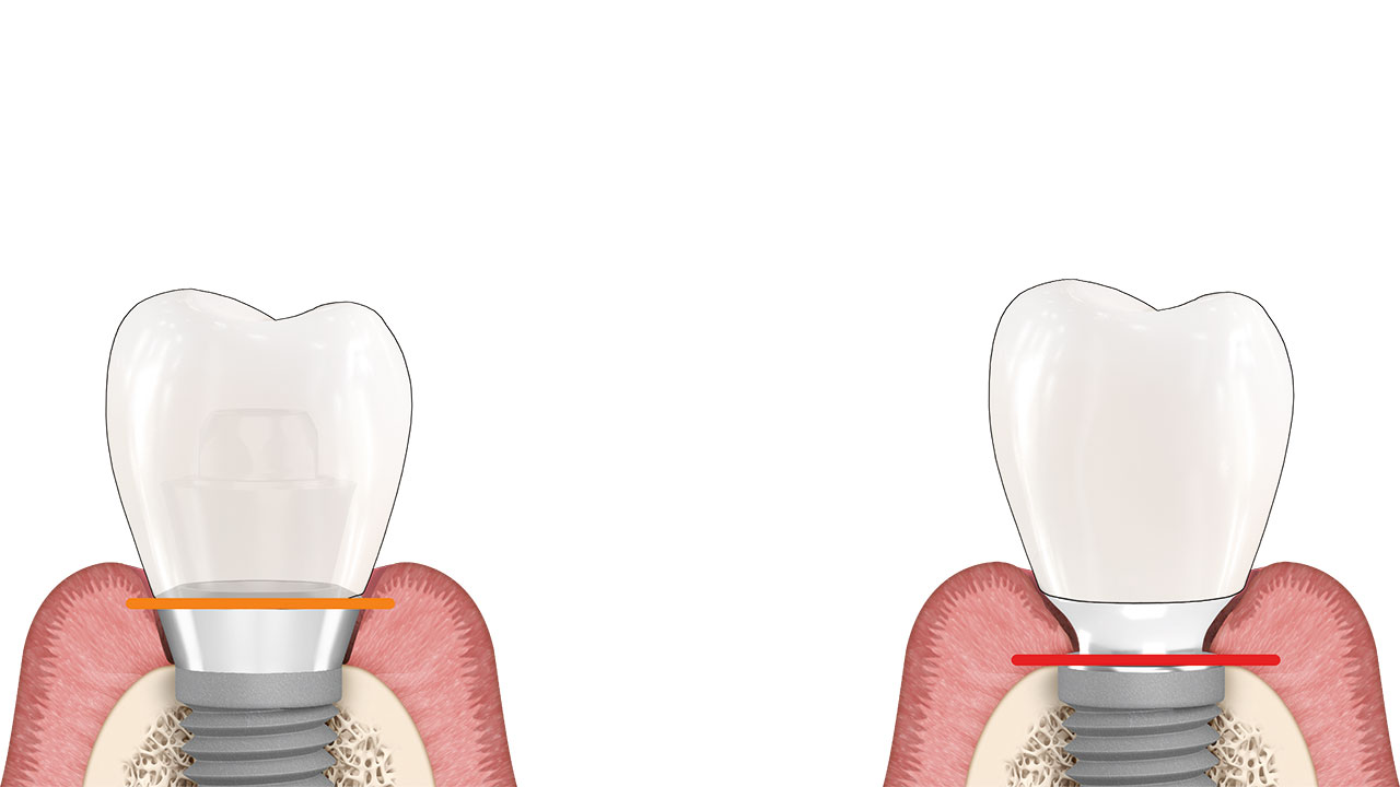 Abb. 4 Vergleich eines Soft-Tissue-Level-Implantats (linke Abbildung) mit einem Bone-Level-Implantat (rechte Abbildung). 