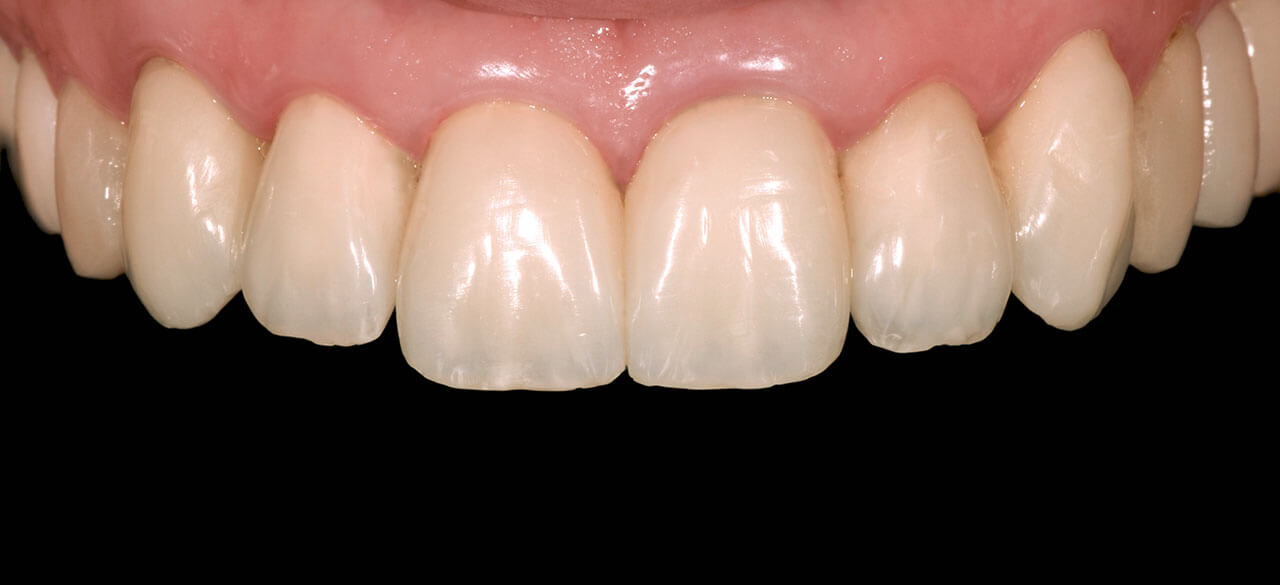 Abb. 30 Die Langzeitprovisorien nach sechs Monaten in situ. Es zeigt sich ein harmonisches Gesamtbild, insbesondere aber stabile parodontale Verhältnisse.