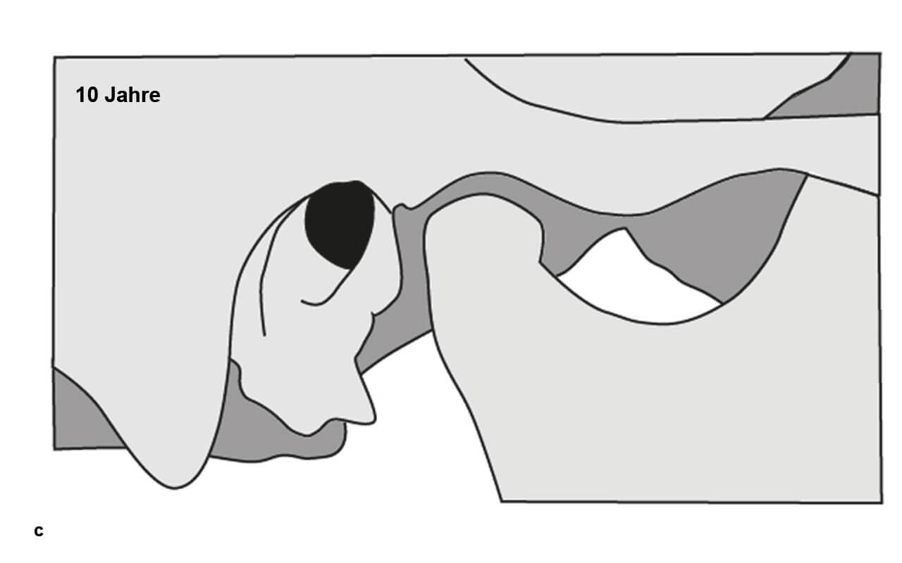Abb. 5 c Mit dem weiteren Zahnwechsel (circa zehn Jahre) hebt sich der Biss weiter und der Condylus und der Proc. coronoideus werden länger und die Fossa mandibularis entsprechend tiefer.