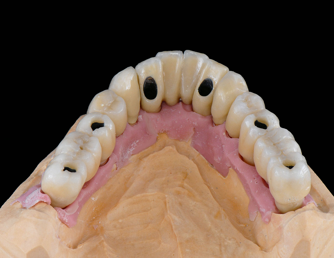 Abb. 30 Das Brennergebnis nach dem ersten Dentinbrand zeigt, dass das Volumen unterdurchschnittlich geschrumpft ist.