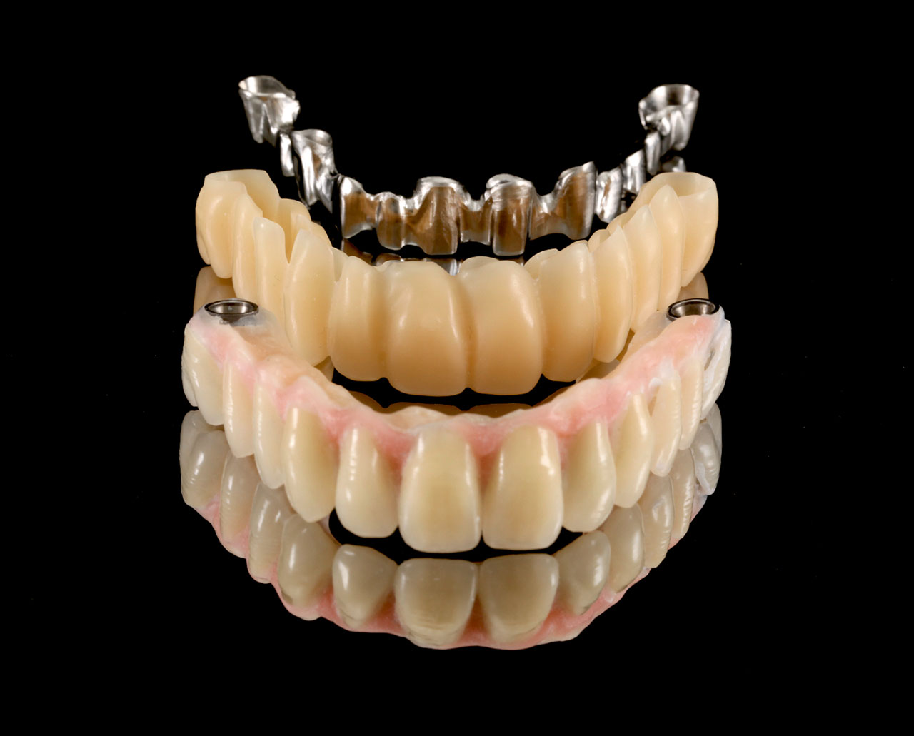 Abb. 11 bis 13 Um zu verhindern, dass zu sehr von der im Set-up erarbeiteten Zielvorgabe mit dem Definitivum abgewichen wird, hat von der Osten Jahr 2010 für das 3Shape Dental System die 2in1-Technik mit erfunden. Diese Technik arbeitet nach dem klassischen Backward-Planning, das heißt bei allen Arbeitsschritten wird auf die eingangs erarbeitete Ästhetik zurückgegriffen.