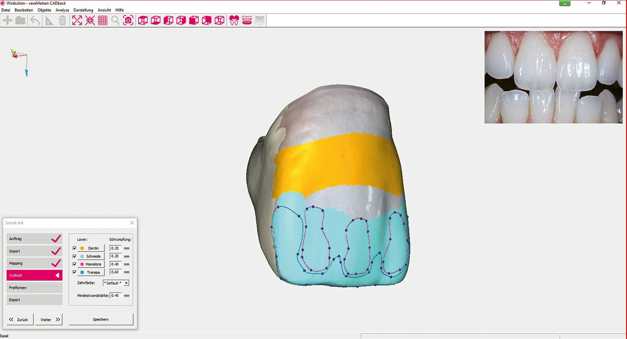 Abb. 6 Arbeiten in der Software ceraMotion CADback. Anlegen der vier Cut-Back-Zonen für das Mikrolayering (Dentin, Schneide, Mamelons und Transpa).