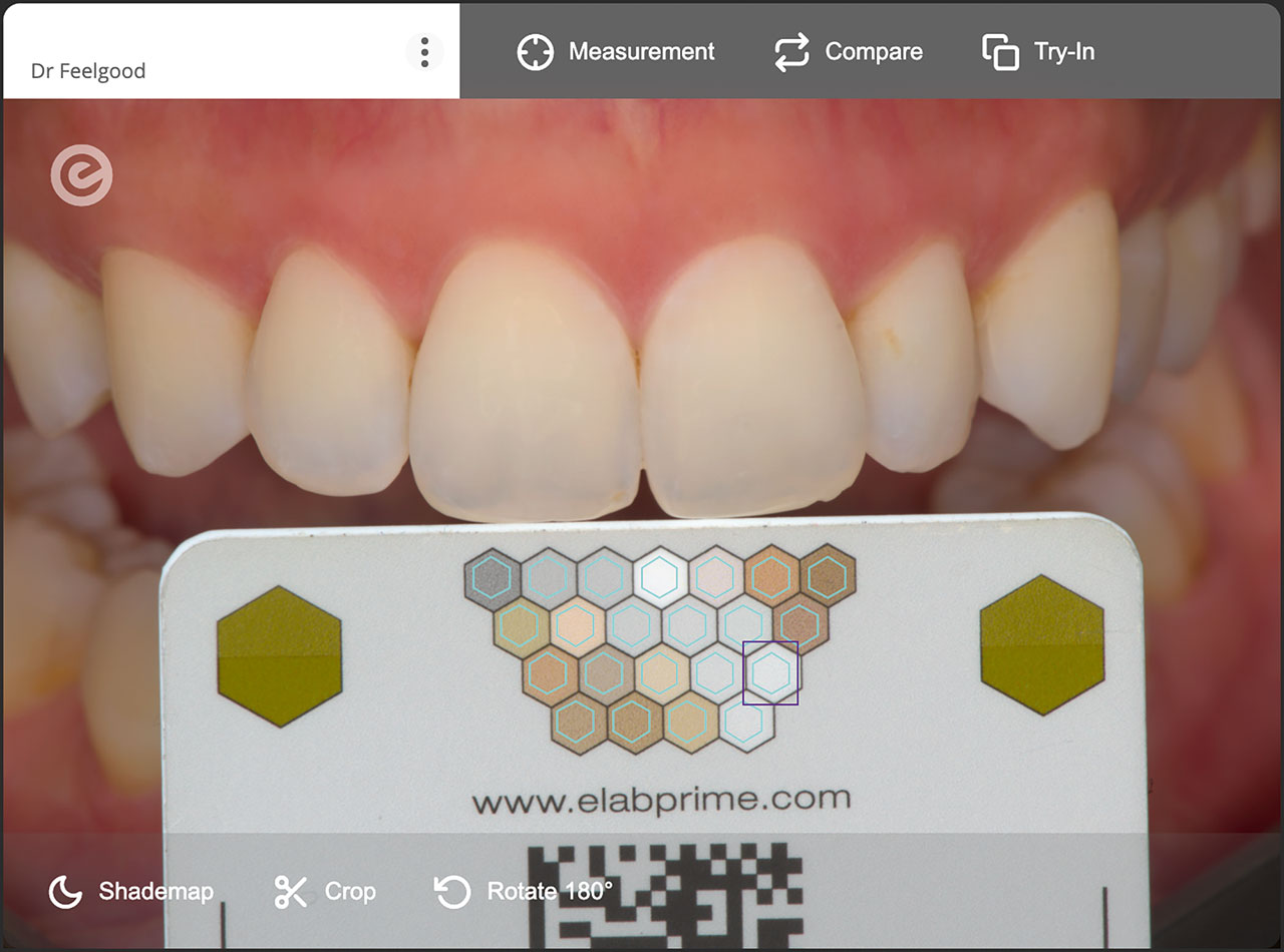 Abb. 3 Das eLAB-System wurde von ZTM Sascha Hein entwickelt und ermöglicht die Messung von Zahnfarben mithilfe standardisierter, breit zugänglicher Dentalfotografie – ganz ohne die Anschaffung teurer Farbmessgeräte.