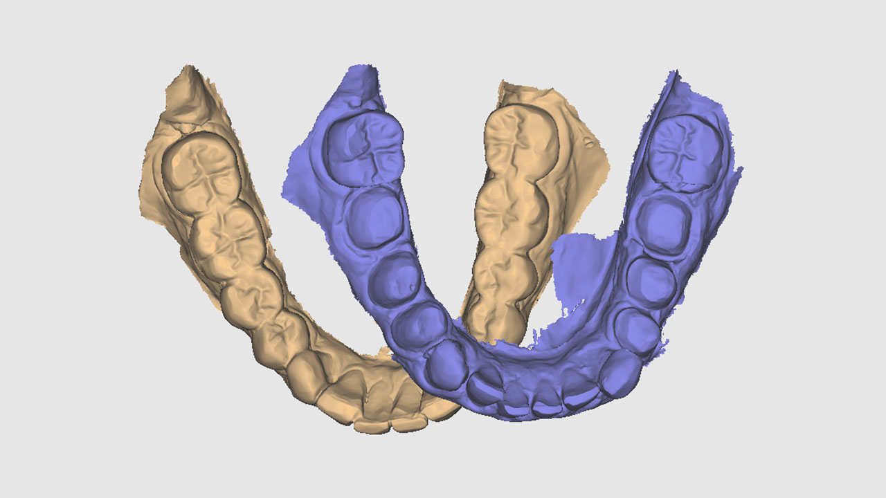 Abb. 2 Der Scan der Ausgangssituation und der der Situation des vorpräparierten Unterkiefers wurden für das Matching in die exocad dentalCAD-Software (Fa. Exocad, Darmstadt) geladen.