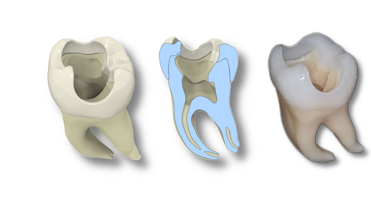 Grafische Darstellung eines großen Backenzahns, von links die Übersicht des ganzen Zahns, dann der Zahn im Querschnitt und der fertige Zahn aus dem 3D-Drucker.