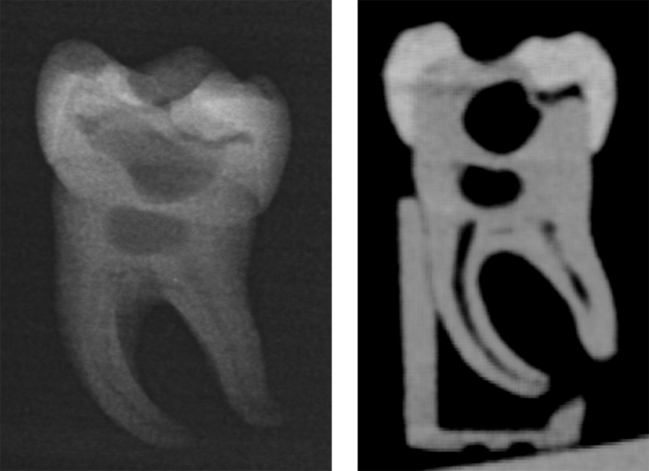links Röntgenaufnahme eines großen Backenzahns aus dem 3D-Druck mit erkennbar löchrigen Innenstrukturen, rechts dreidimensionale Röntgenaufnahme (DVT) des gedruckten Zahns