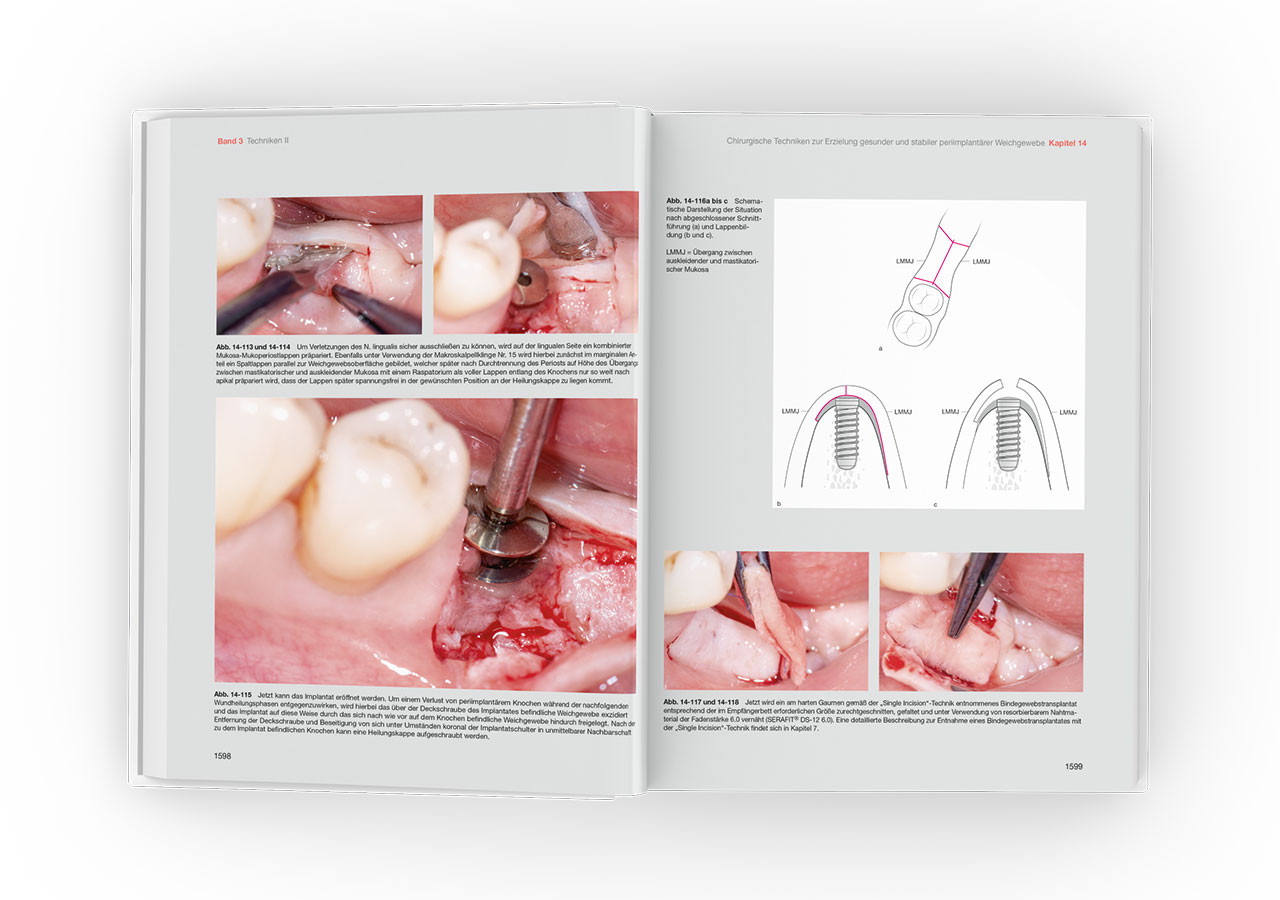 Abb. 4 Auch im dritten Band werden chirurgische Techniken vorgestellt, beispielsweise im Kapitel 14, in dem es um die Erzielung gesunder und stabiler periimplantärer Weichgewebe geht.