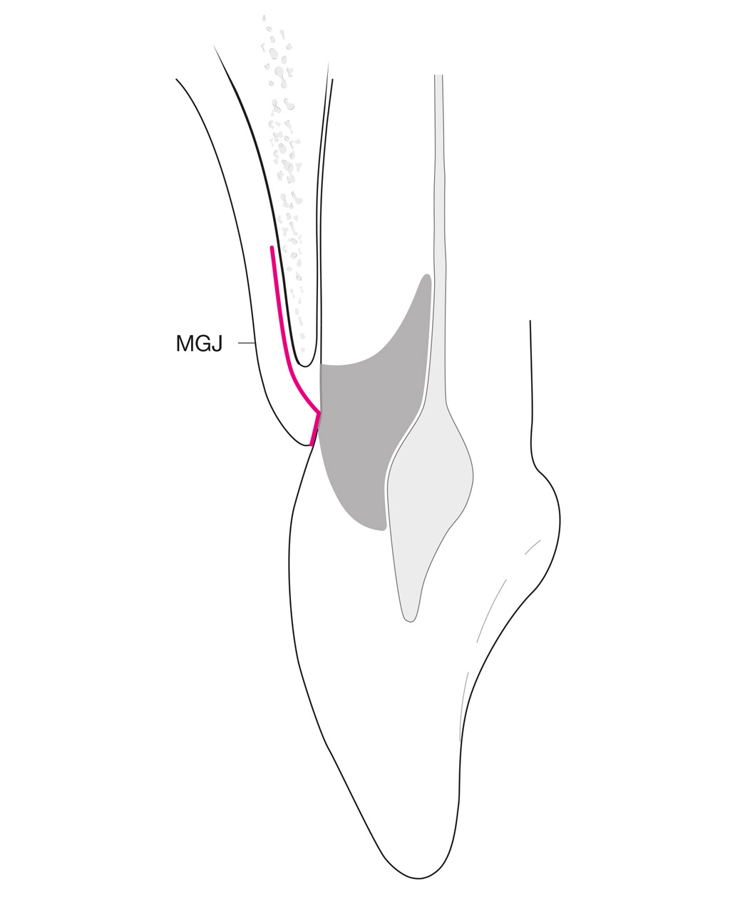 Schematische Darstellung der Lappenpräparation (MGJ = mukogingivale Grenzlinie)