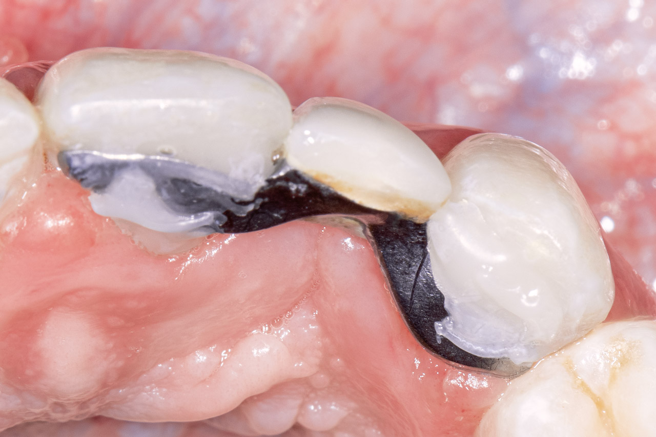 Ausgangssituation intraoral