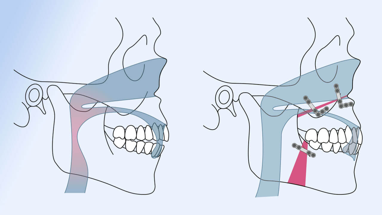 Chirurgische Therapie des obstruktiven Schlafapnoe-Syndroms