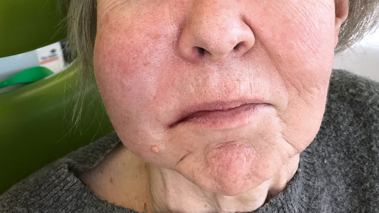 Klinisches Bild der unteren Gesichtshälfte einer älteren Patientinauf einem zahnärztlichen Behandlungsstuhl mit angeschwollener rechter Wange.