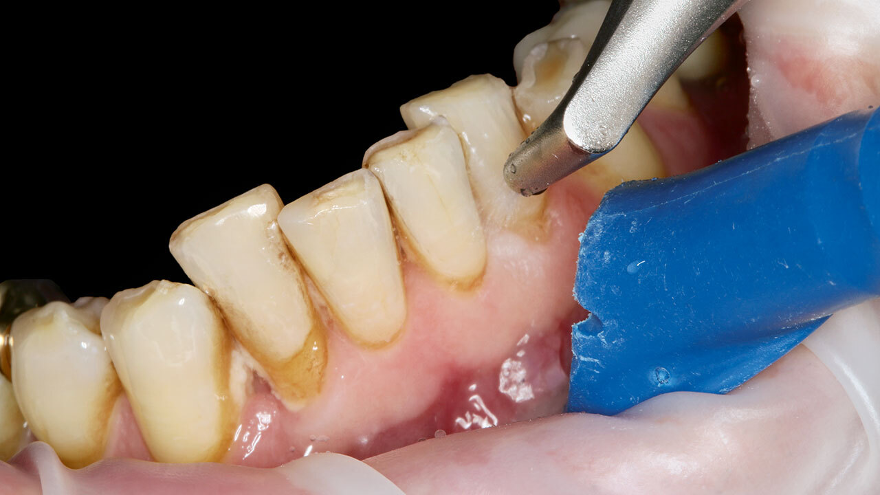 Klinisches Bild zeigt die Anwendung eines Pulverstrahlgeräts zur Reinigung von Unterkieferzähnen mit einem blauen Zahnfleischschutz auf der rechten Bildhälfte.