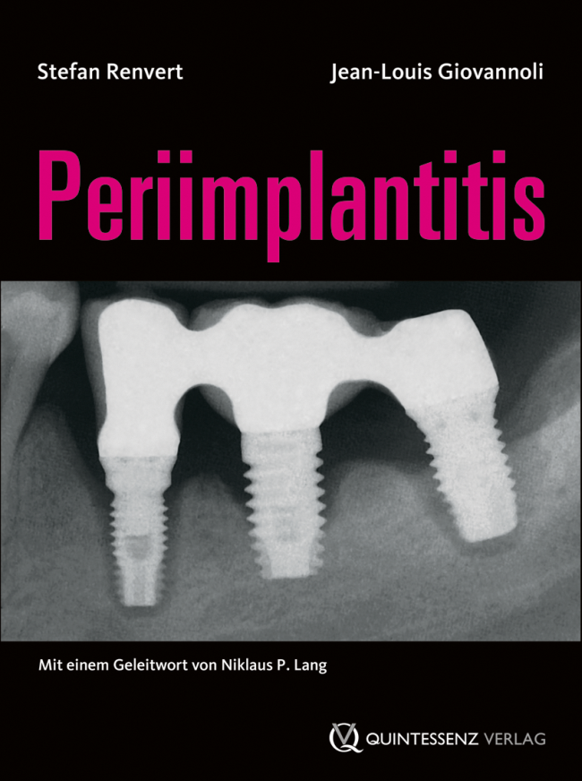 Renvert: Periimplantitis