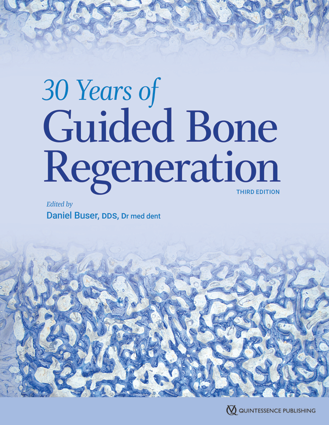 Buser: 30 Years of Guided Bone Regeneration