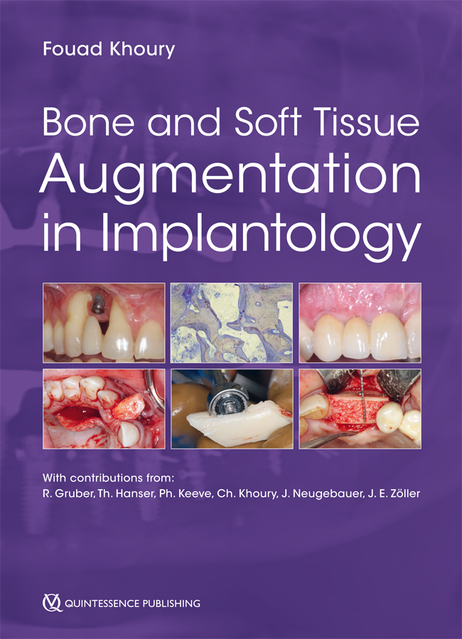 Khoury: Bone and Soft Tissue Augmentation in Implantology