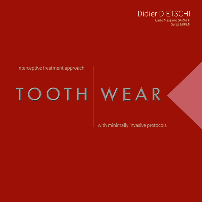 Dietschi: Tooth Wear