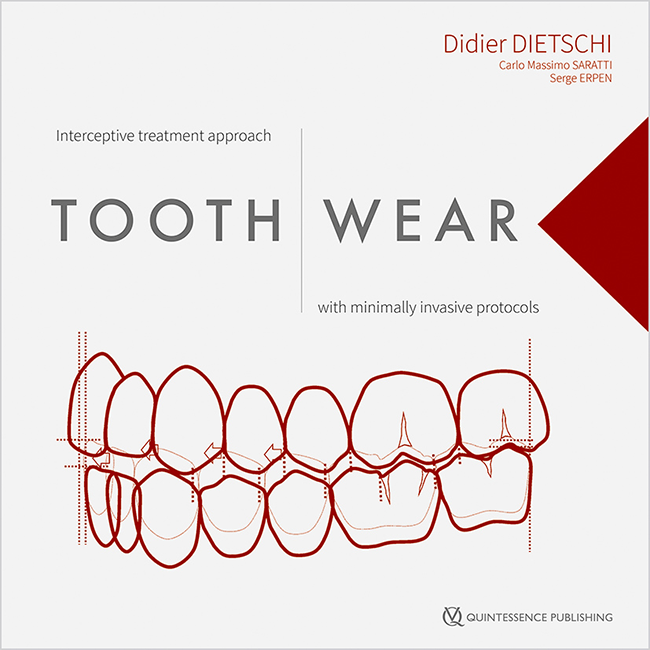 Dietschi: Tooth Wear