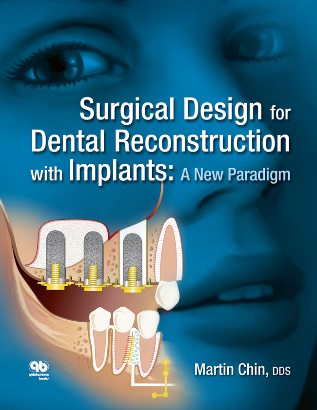 Chin: Surgical Design for Dental Reconstruction with Implants